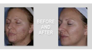acne and acne scars